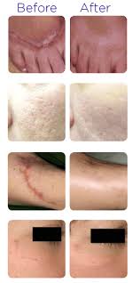 How much does laser hair removal cost? Scar Removal Acne Scar Removal Philadelphia Pa Lancaster Harrisburg Bucks County Chester Springs Pa