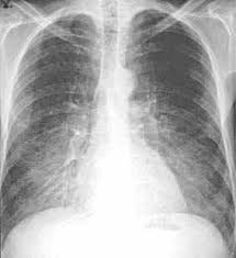 Radiologie Roentgen Diagnose Lungenkrankheiten Roentgenzeichen Dd Differentialdiagnose Fur Den Handheld In Der Kitteltasche Oder Befundungsmonitor