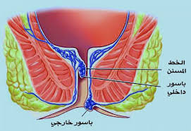شكل البواسير الخارجية بالصور الحقيقية صحتنا