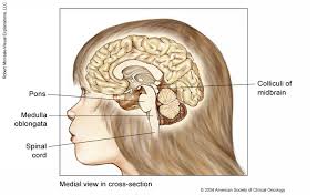 It often presents with nonspecific symptoms similar to those of benign conditions, leading to delays in the diagnosis and initiation of appropriate treatment. Brain Stem Glioma Childhood Medical Illustrations Cancer Net