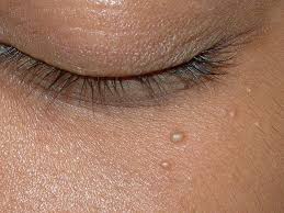 You Probably Have Milia Here S What They Are And How To Treat Them Visage Boutons Sous La Peau Comment Enlever Les Boutons