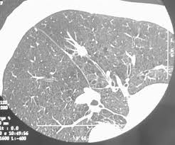 They can be really useful for finding cancers in the earliest stages before the patient exhibits any symptoms. What Benefits Can I Expect From Ct Scan Lung Cancer Screening Lung Cancer Ct Screening