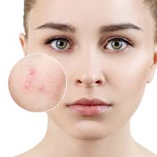 Bị mụn bọc có để lại sẹo? Đâu là cách trị mụn bọc hiệu quả? • Hello Bacsi