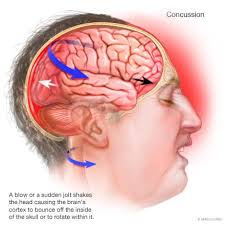 The concussion from the explosion broke windows three blocks away. Concussion Sports Medicine