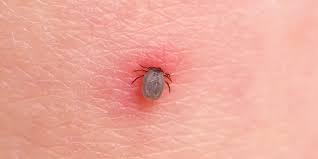 Image result for infected tick bite
