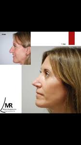 RINOPLASTIA ULTRASONICA., 1ª CONSULTA INFORMATIVA ONLINE GRATUÍTA.,  https://calendar.app.google/jx67gCgraopcFszu5, Dr. Melchor., Rinoplastia  Estética y funcional. , La Rinoplastia Ultrasónica se basa ...