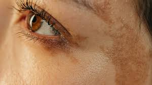 Reducing Pigmentation and Sun Damage with Dermapen Microneedling