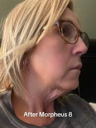 Morpheus 8 Results After 3 Treatments