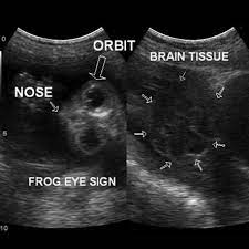 Frog Eye Sign In Enencephaly Less Than Expected Value For Crown Rump Length Crl O Diagnostic Medical Sonography Ultrasound Sonography Cardiac Sonography
