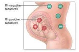 Image result for Rh Sensitization