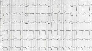 Un electrocardiograma puede detectar infartos o arritmias. Myocarditis Electrocardiogram Wikidoc