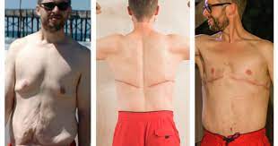 In 1967, the first gastric bypass surgery was performed by ito and mason at the university of your surgeon will visit with you a couple of times after surgery and before you are discharged. Plastic Surgery After Weight Loss With Plastic Surgeons In Austin Tx A Skin Tight Story Synergy Plastic Surgery