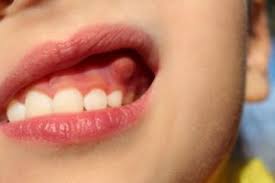 Maybe you would like to learn more about one of these? Dentist Why Do I Have Bump On Gums Dr Durga Devarakonda