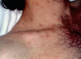 Image result for skin rash acute hiv infection
