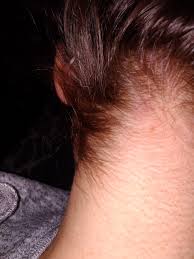 I had very bad sides with oral finasteride and even worse with topical finasteride. Diffuse Thinning And Severe Nape Hair Loss Heralopecia Forums