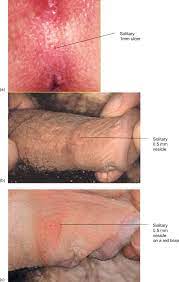 I remember sitting in excruciating pain in a room in the er, in front of a nurse and an ob/gyn, trying not to ugly cry. Hsv Shedding Sciencedirect