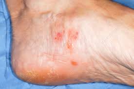 Image result for pompholyx soles of feet