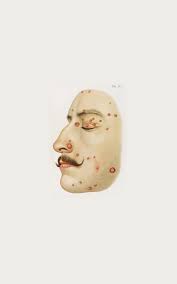 The Sick Rose Disease And The Art Of Medical Illustration The Sick Rose Medical Illustration Of Diseases And Decay Medical Illustration Human Anatomy Drawing Drawings