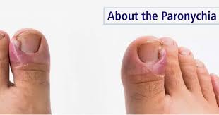 Image result for Paronychia feet