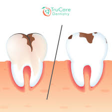 While those marks can be difficult to conquer. Cavity Vs Stain Everything You Should Know Trucare Dentistry Roswell
