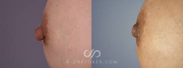 Nipple - Reduction Before and After Pictures Case 229 | Los Angeles, CA |  Stoker Aesthetics