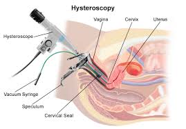 Hysteroscopy What You Should Know Endometriosis And Infertility Polyps Uterus Cervix Uteri