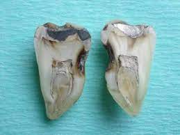 Cross Section Of A Tooth Revealing Pulp Stones Pulp Stones Are Foci Of Calcification In The Dental Pulp They Can Occur As A S Dental Dance Shoes Ballet Shoes