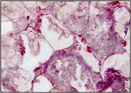 Necrotizing fasciitis is caused most commonly by streptococcus pyogenes, group a streptococcus, which is the same bacteria that causes common strep throat 8. Zygomycotic Necrotizing Fasciitis In Immunocompetent Patients A Series Of 18 Cases Modern Pathology