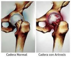 Porque Me Duele En La Ingle Sera La Cadera Zona Hospitalaria