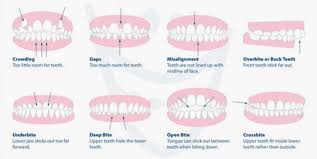Anterior crossbites and posterior crossbites. How To Fix A Crossbite In Adults Arxiusarquitectura