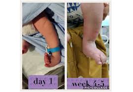 Learn more from boston children's hospital. My Baby Has Clubfoot