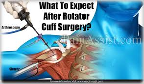 What To Expect After Rotator Cuff Surgery Recovery Period Rotator Cuff Surgery Recovery Rotator Cuff Surgery Rotator Cuff