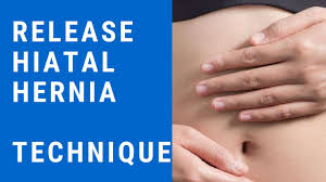 It occurs when the upper part of the stomach protrudes into the chest through the weak part. Release Hiatal Hernia Relieve Gerd Asthma Heart Palpitation Youtube
