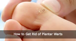 Many people can live with the warts and never to contact about in the photo you can see the different types of warts localized in feet. How To Get Rid Of Plantar Warts Academic Association Of Medicine