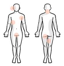 The area of interior wall between a window stool and the floor. What Is Hidradenitis Suppurativa Hs No Bs About Hs