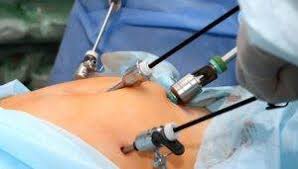 Laparoscopic Surgery for Fibroids ...