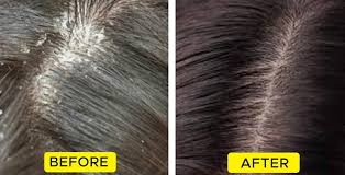How To Get Rid Of Dandruff Fast Permanently Naturally
