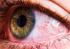 Itchy Red Eyes How To Tell If It S Allergy Or Infection Cleveland Clinic