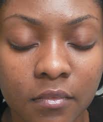 Acne and Rosacea: Epidemiology, Diagnosis and Treatment