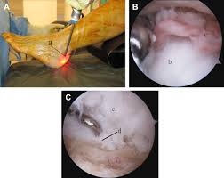 Learn more about haglund's deformity here. Minimally Invasive And Endoscopic Treatment Of Haglund Syndrome Foot And Ankle Clinics