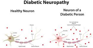 The best way to prevent diabetic neuropathy is by controlling blood glucose levels. Pain And Sleep Diabetic Neuropathy