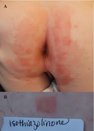 Image result for dermatitis contacta children
