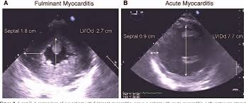 Chris is an intensivist and ecmo specialist at the alfred icu in melbourne. Fulminant Myocarditis The Role Of Perioperative Echocardiography Semantic Scholar