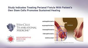 Information about symptoms, treatment, and diagnosis of fistulas, a type of complication that is more common in people with crohn's disease. Study Indicates Treating Perianal Fistula With Patient S Own Stem Cells Promotes Sustained Healing World Stem Cell Summit