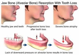 Free Implant Consult Package