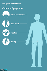 Prolapsed Hemorrhoids: Symptoms, Causes, and Treatment