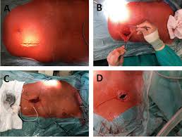Diese pumpe mit peleusball hat eine kammerlänge von stattlichen 21 cm und einen kammerdurchmesser von 6,3 cm. Periprocedural Safety And Outcome After Pump Implantation For Intravenous Treprostinil Administration In Patients With Pulmonary Arterial Hypertension Bmc Pulmonary Medicine Full Text