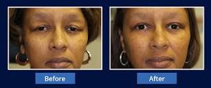 Cosmetic Laser Eye Surgery Fairfax | Laser Blepharoplasty VA