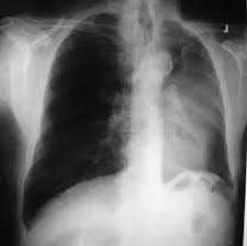 Amanda nerstad thought she had mild walking pneumonia but was diagnosed with stage 4 lung cancer. Is It Common Or Rare For Doctors To Misdiagnose Lung Cancer With Pneumonia Using Chest X Ray Non Contrast Ct Quora