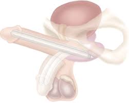 Image result for Penile Prosthesis